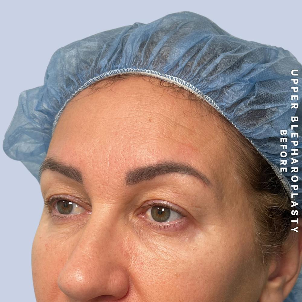 Eyes Before & After Gallery - Patient 165041 - Image 3