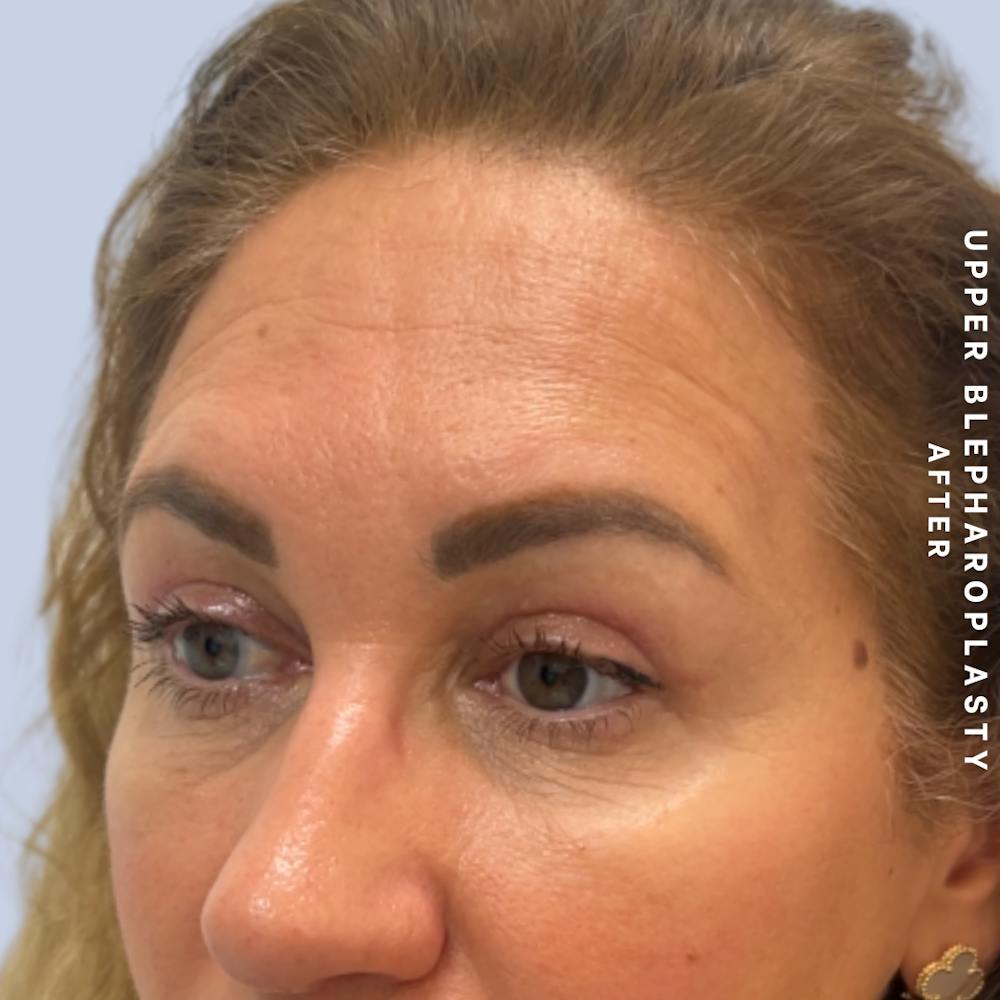 Eyes Before & After Gallery - Patient 165041 - Image 4