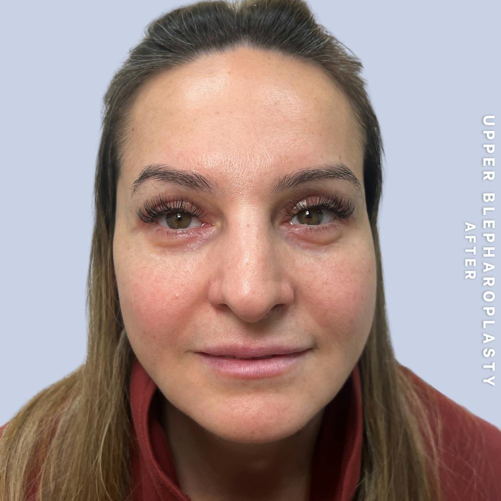 Eyes Before & After Gallery - Patient 122505 - Image 2