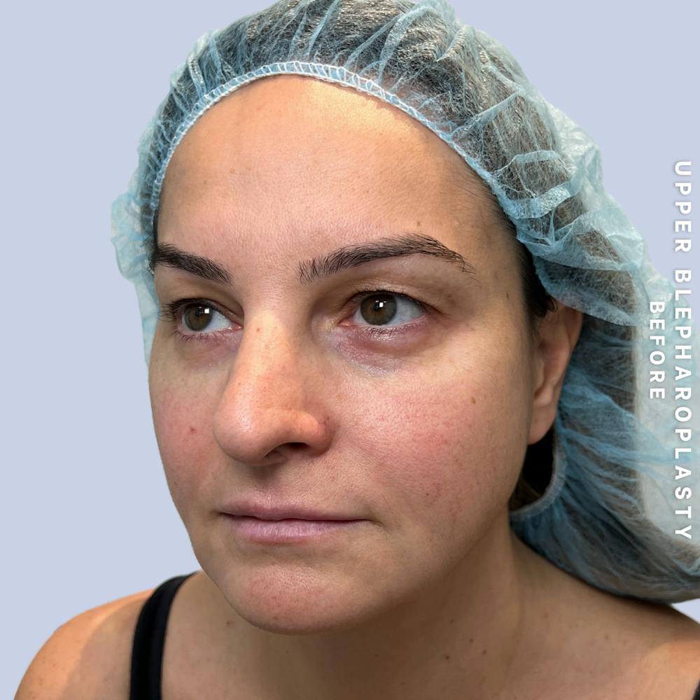 Eyes Before & After Gallery - Patient 122505 - Image 5