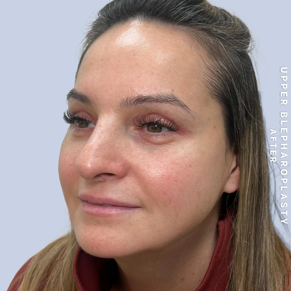 Eyes Before & After Gallery - Patient 122505 - Image 6
