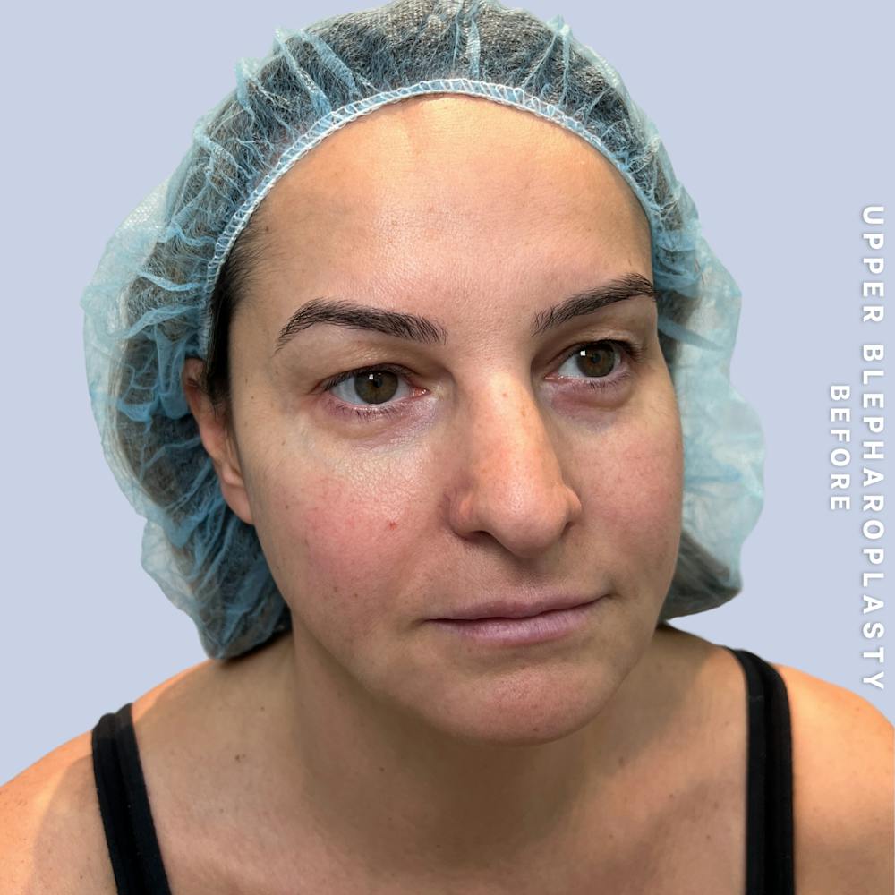Eyes Before & After Gallery - Patient 122505 - Image 3