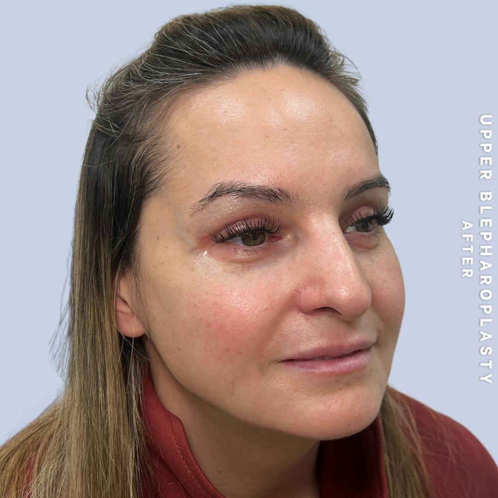Eyes Before & After Gallery - Patient 122505 - Image 4