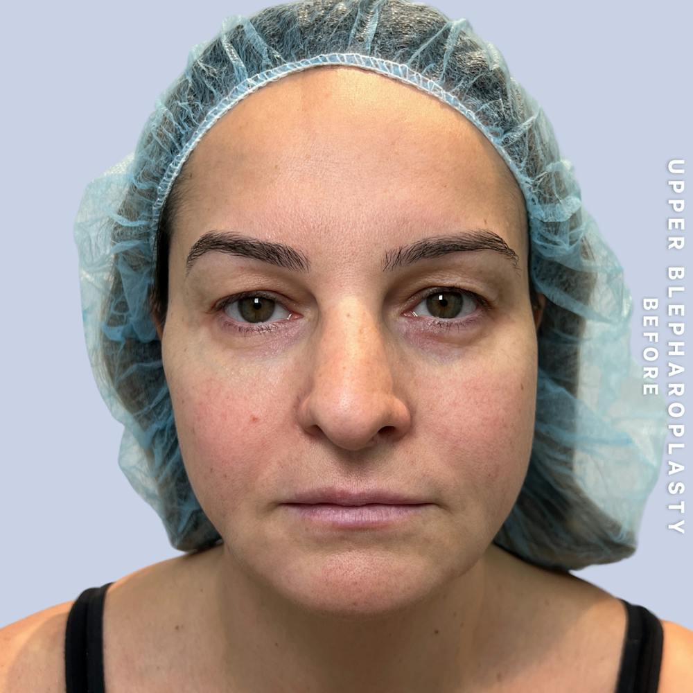 Eyes Before & After Gallery - Patient 122505 - Image 1
