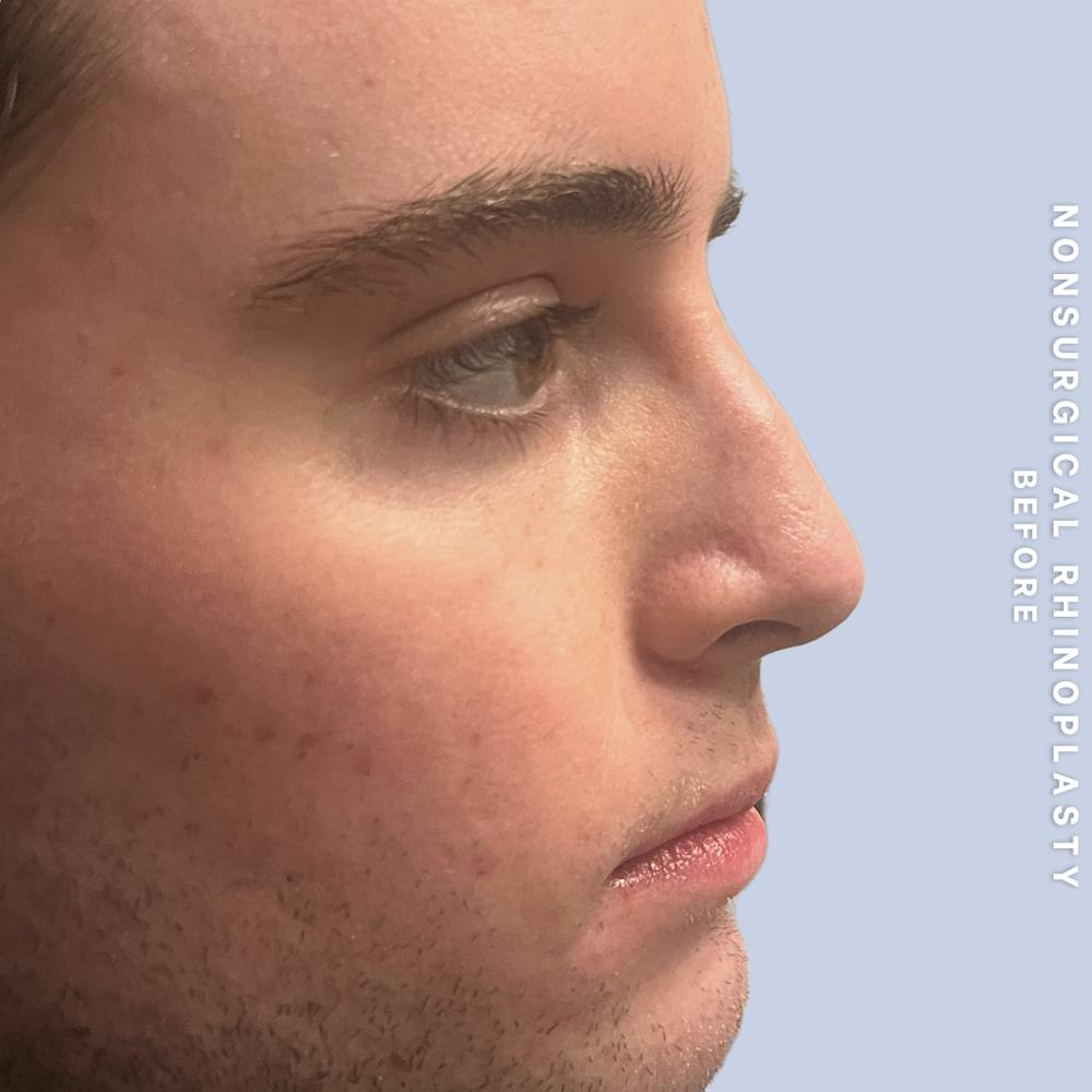 Non-Surgical Nose Before & After Gallery - Patient 399673 - Image 1