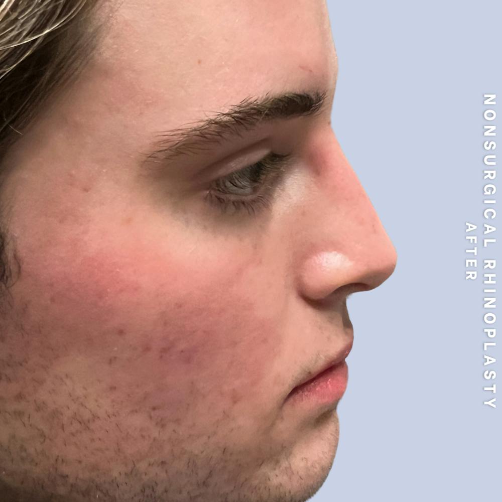Non-Surgical Nose Before & After Gallery - Patient 399673 - Image 2