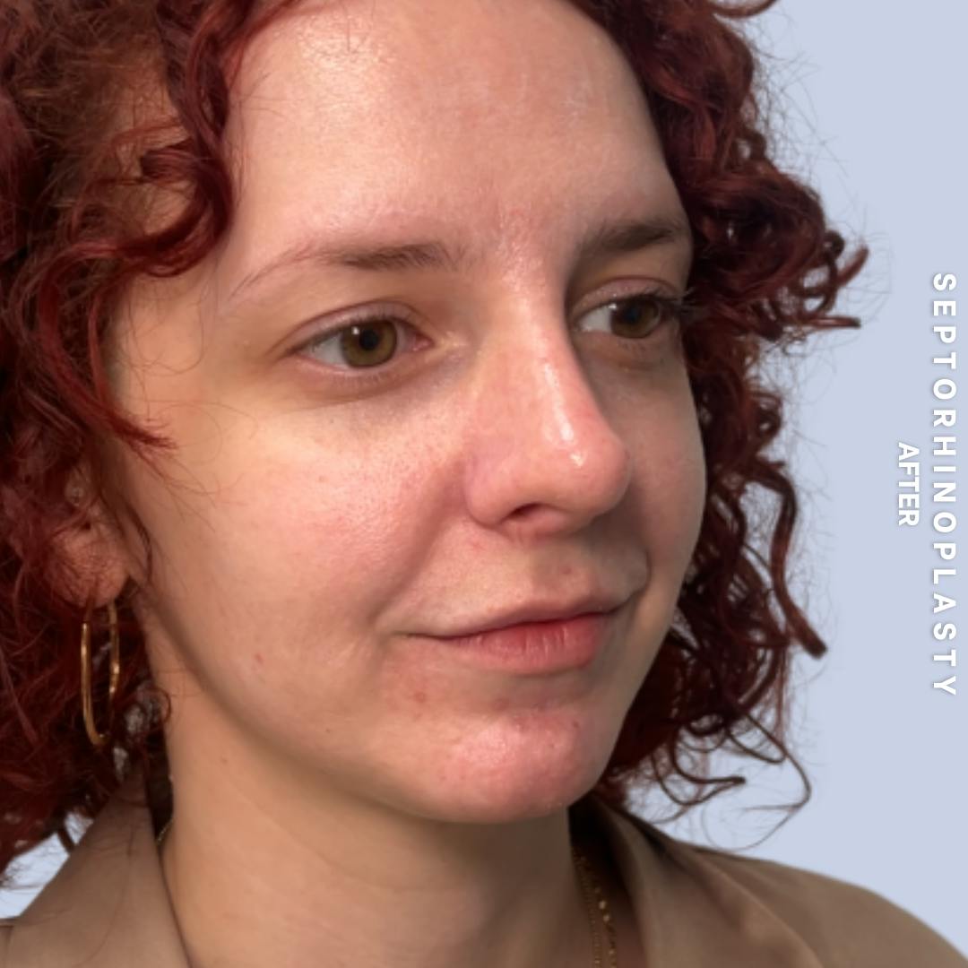 Nose Before & After Gallery - Patient 357016 - Image 4