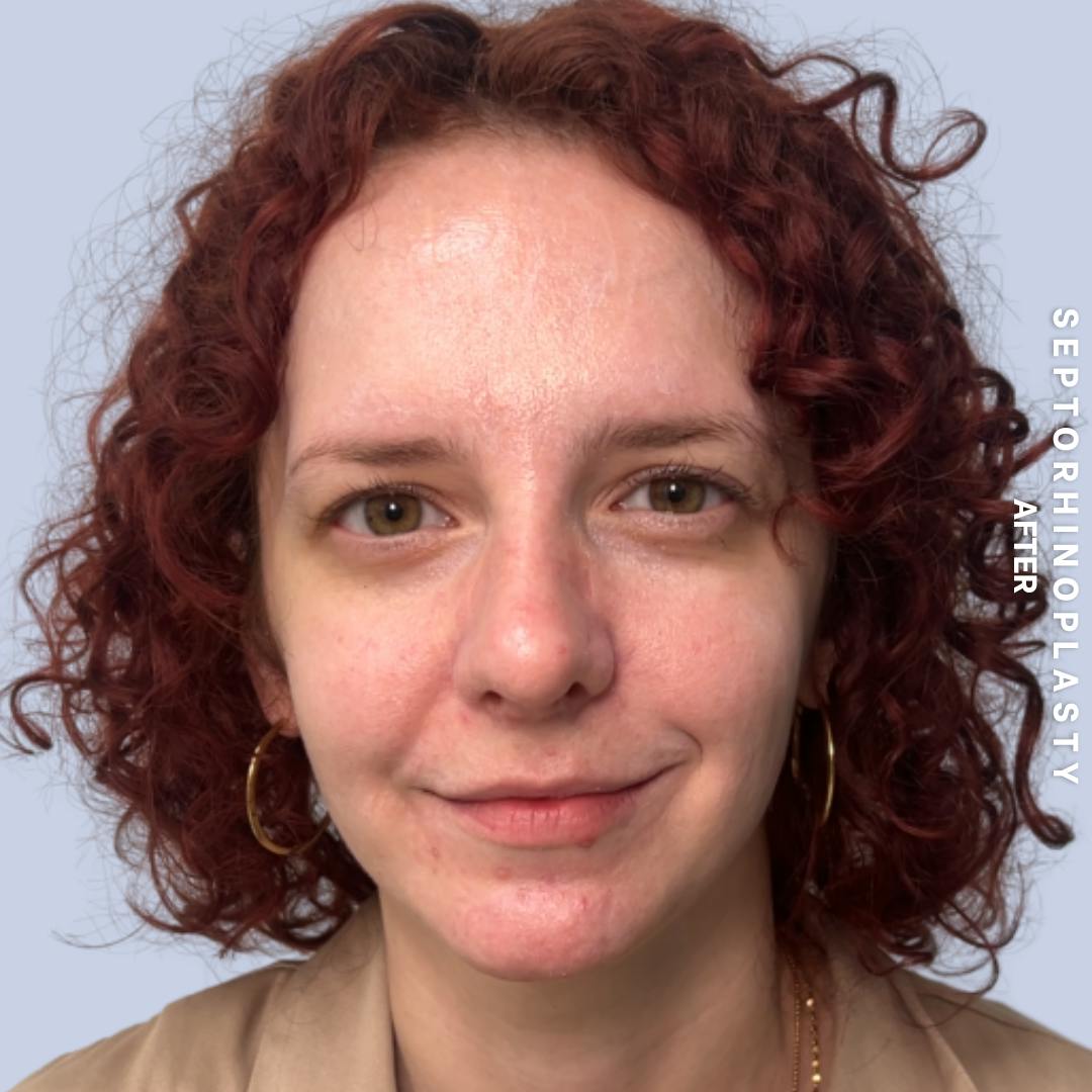 Nose Before & After Gallery - Patient 357016 - Image 2