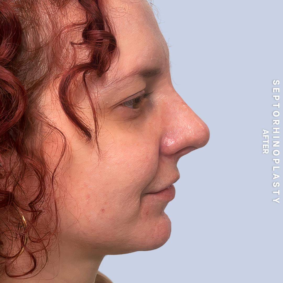 Nose Before & After Gallery - Patient 357016 - Image 6