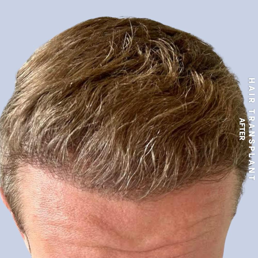 Men's Hair Before & After Gallery - Patient 359931 - Image 2
