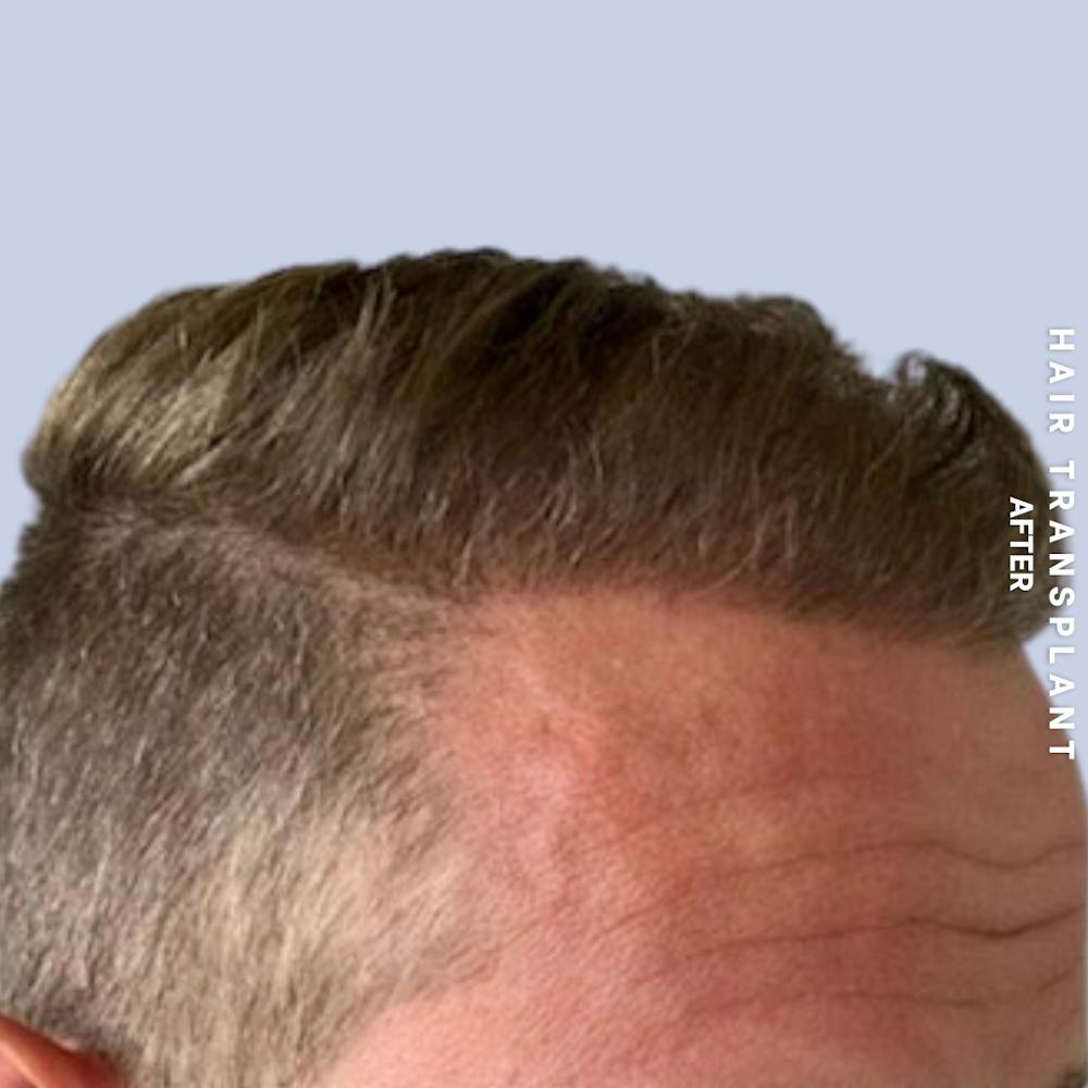 Men's Hair Before & After Gallery - Patient 359931 - Image 4