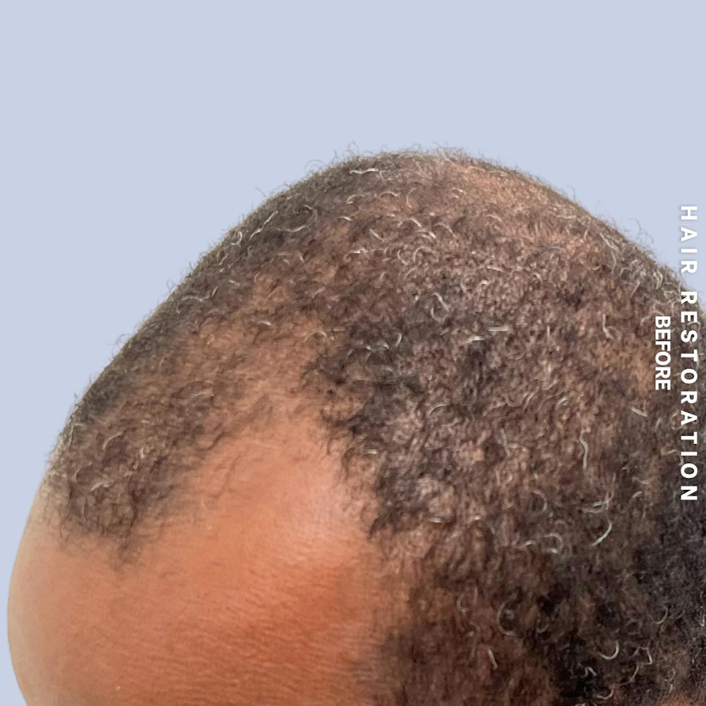 Men's Hair Before & After Gallery - Patient 121417581 - Image 7