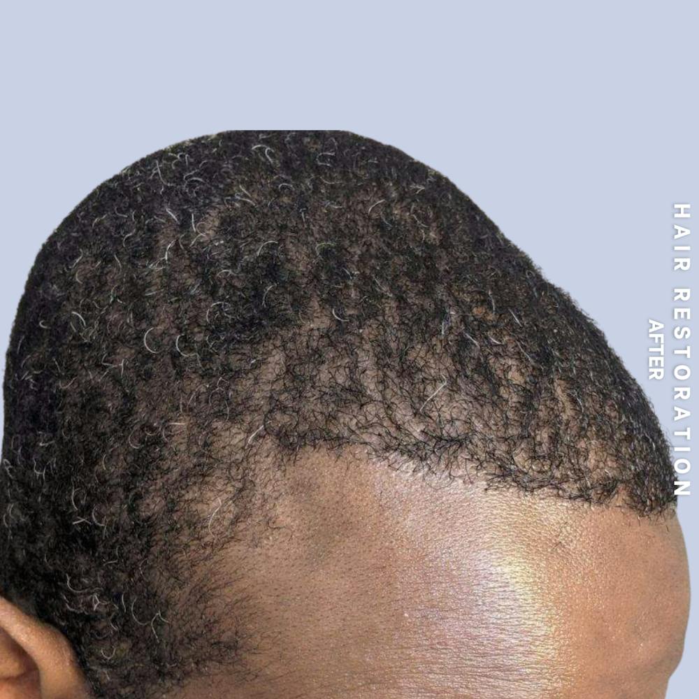 Men's Hair Before & After Gallery - Patient 121417581 - Image 6