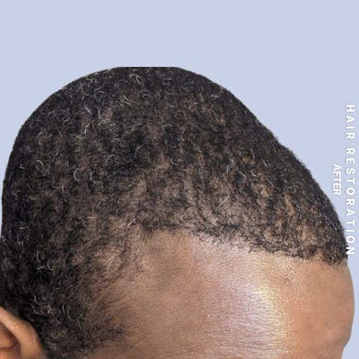 Men's Hair Before & After Gallery - Patient 121417581 - Image 6