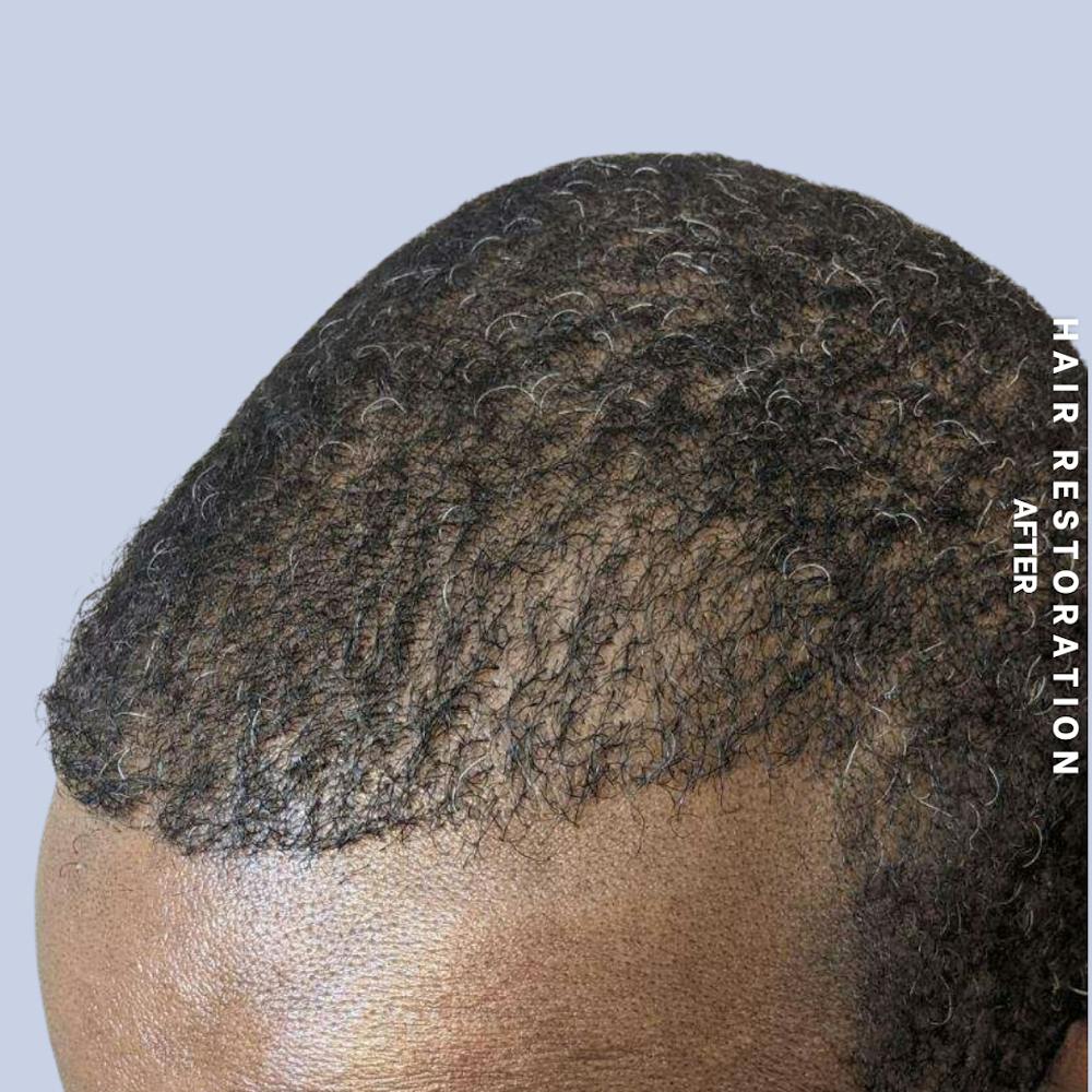 Men's Hair Before & After Gallery - Patient 121417581 - Image 8