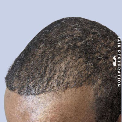 Men's Hair Before & After Gallery - Patient 121417581 - Image 8