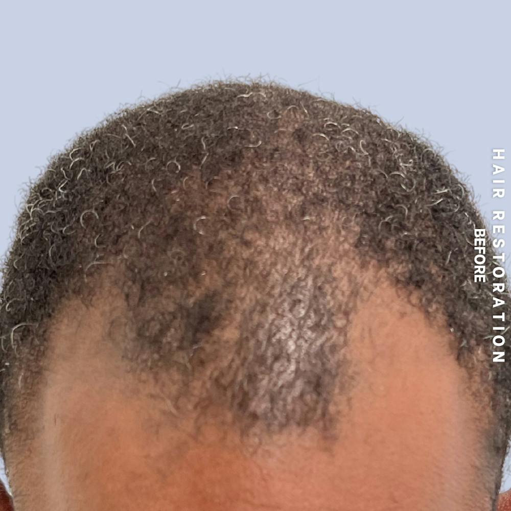Men's Hair Before & After Gallery - Patient 121417581 - Image 3
