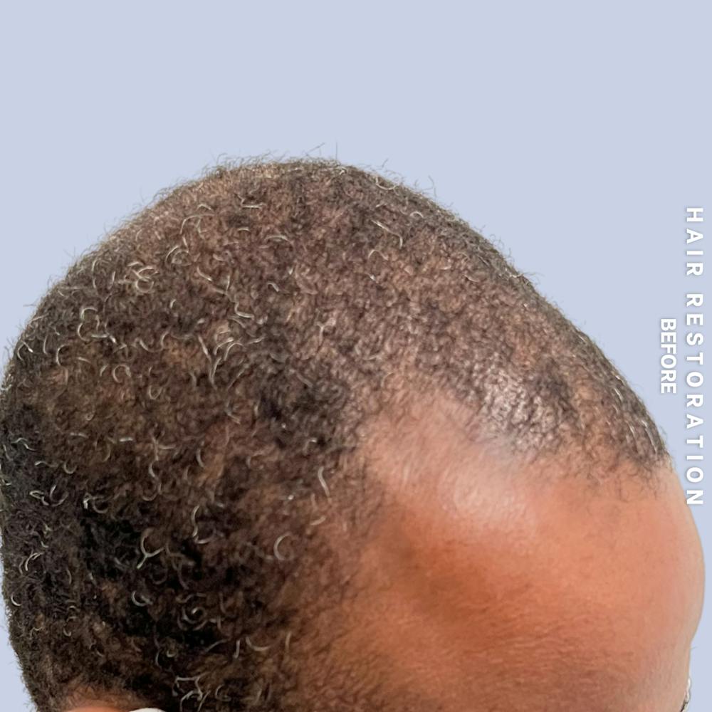 Men's Hair Before & After Gallery - Patient 121417581 - Image 5
