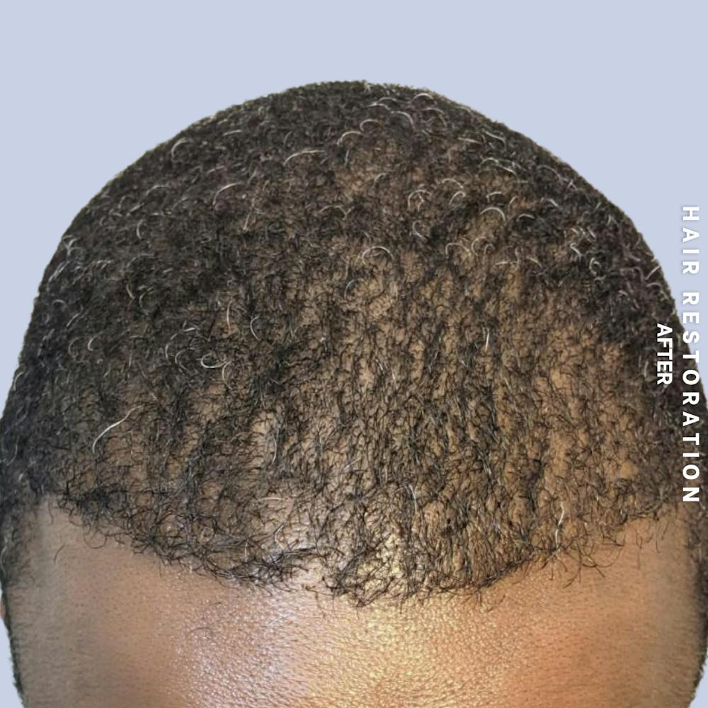 Men's Hair Before & After Gallery - Patient 121417581 - Image 4