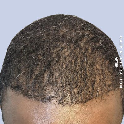 Men's Hair Before & After Gallery - Patient 121417581 - Image 4