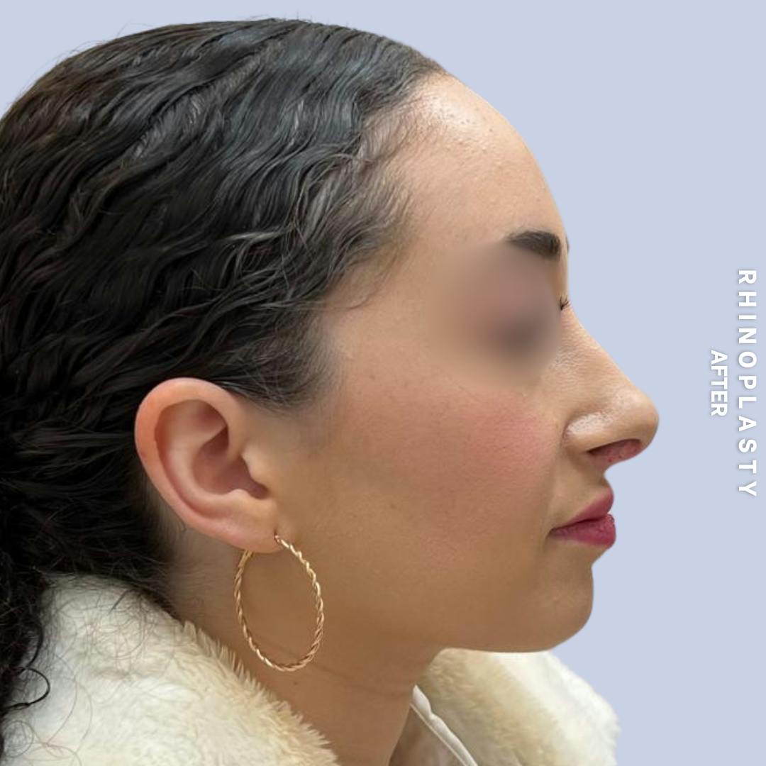 Nose Before & After Gallery - Patient 120868462 - Image 4