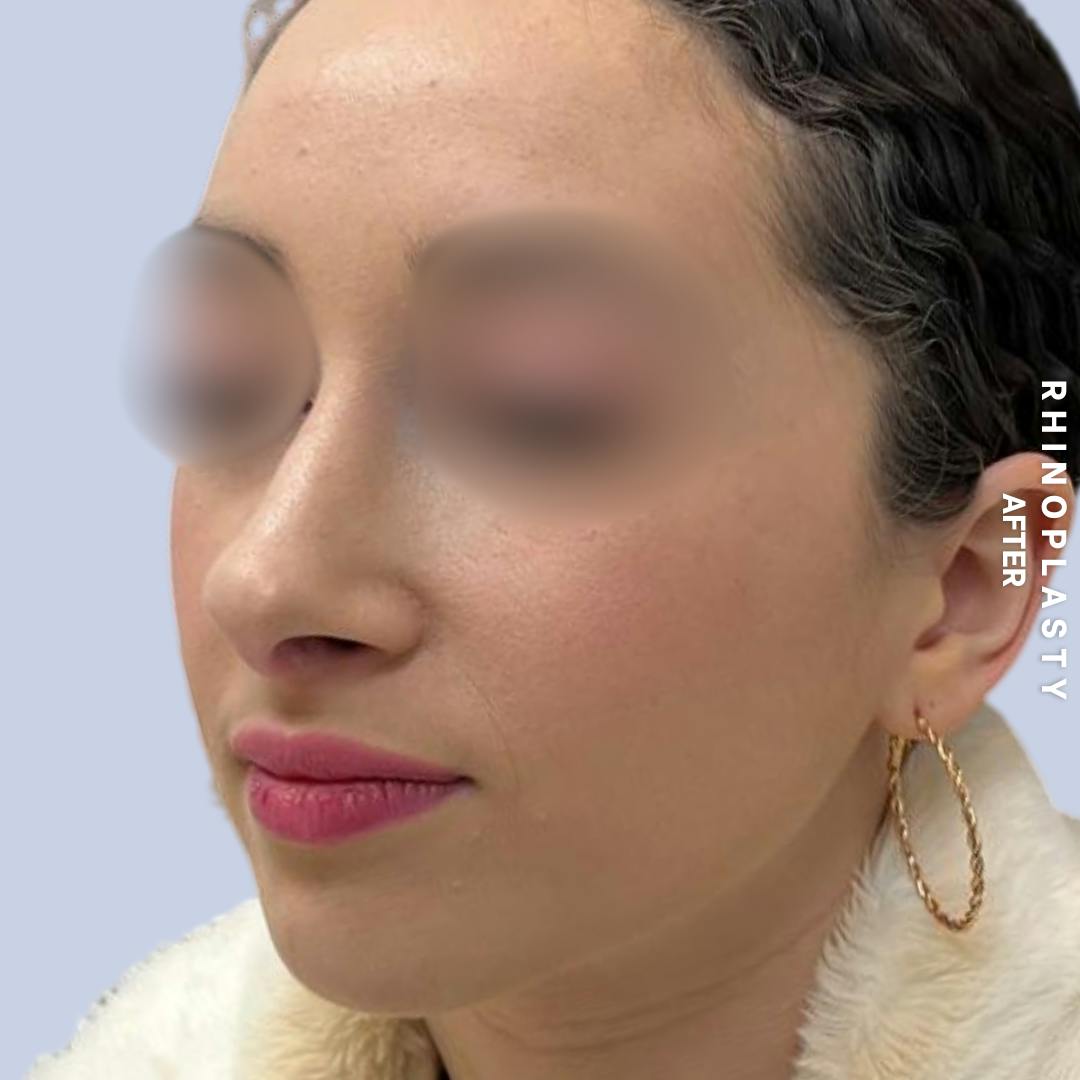 Nose Before & After Gallery - Patient 120868462 - Image 6