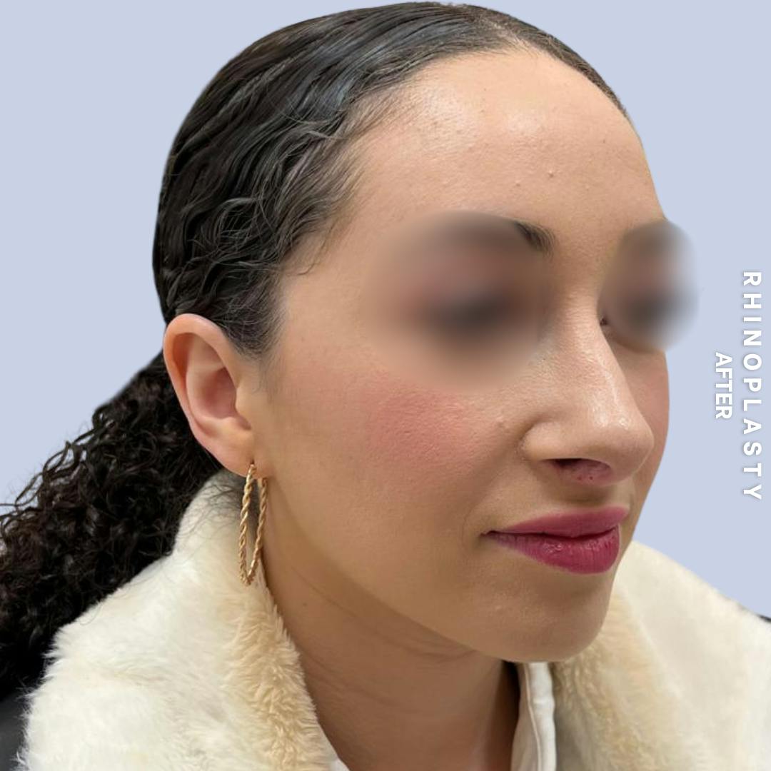 Nose Before & After Gallery - Patient 120868462 - Image 2