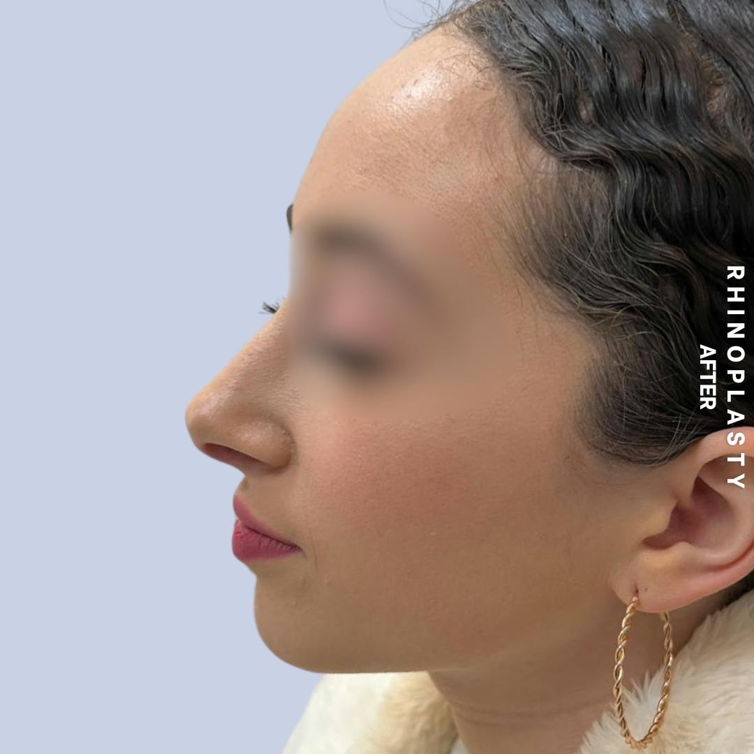 Nose Before & After Gallery - Patient 120868462 - Image 8