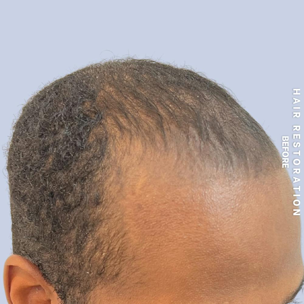 Hair Restoration Before & After Gallery - Patient 367978 - Image 3