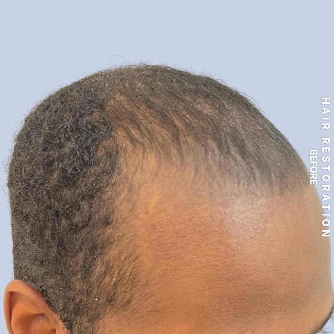 Hair Restoration Before & After Gallery - Patient 367978 - Image 3