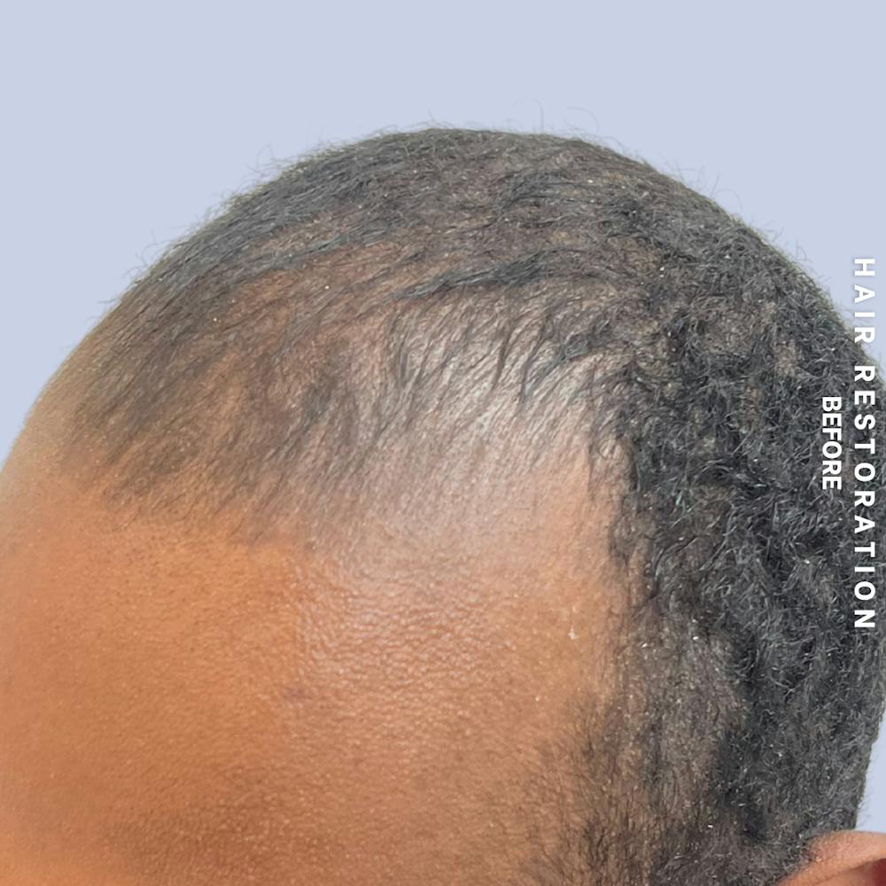 Hair Restoration Before & After Gallery - Patient 367978 - Image 5