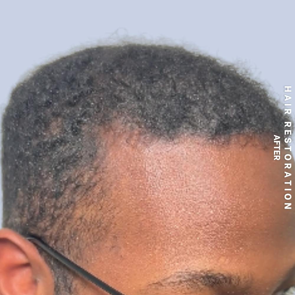 Hair Restoration Before & After Gallery - Patient 367978 - Image 4