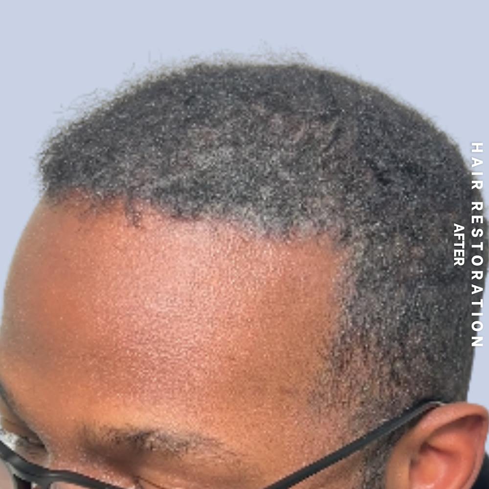 Hair Restoration Before & After Gallery - Patient 367978 - Image 6
