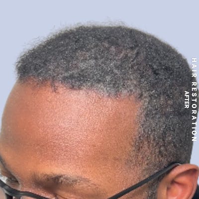 Hair Restoration Before & After Gallery - Patient 367978 - Image 6