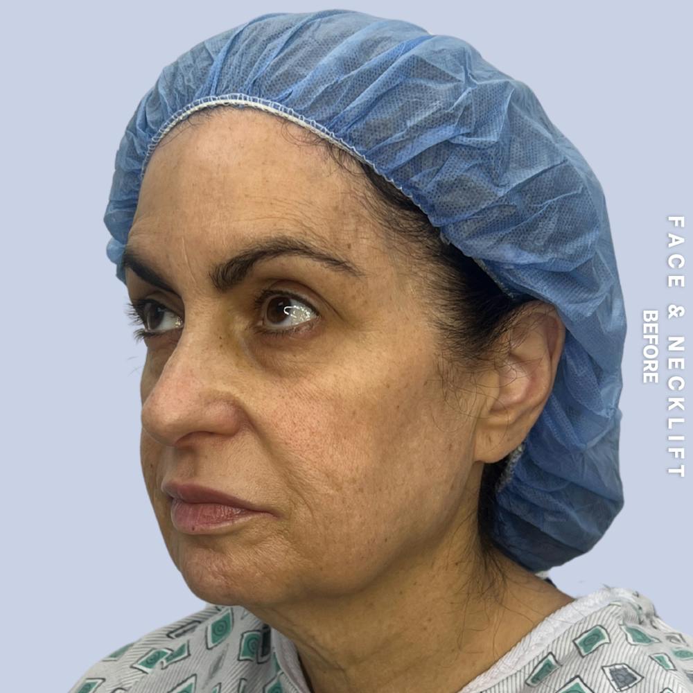 Face & Neck Before & After Gallery - Patient 271682 - Image 7