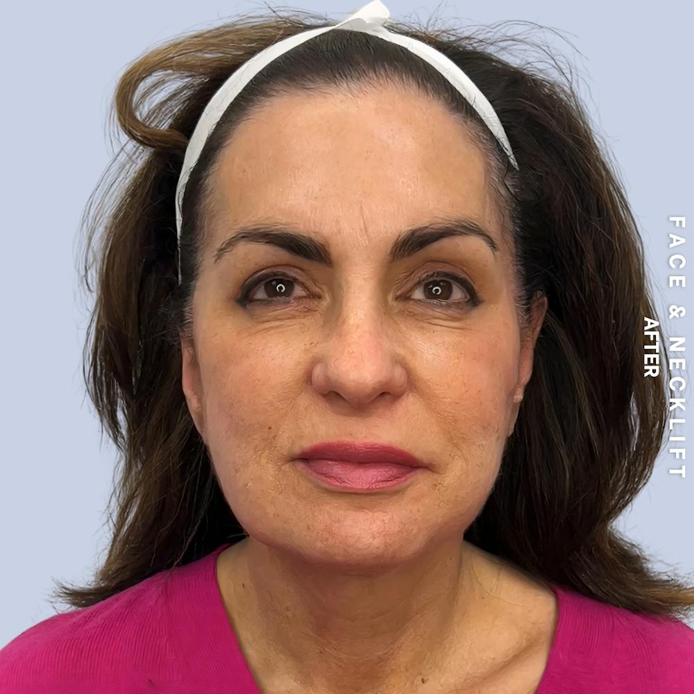 Face & Neck Before & After Gallery - Patient 271682 - Image 2