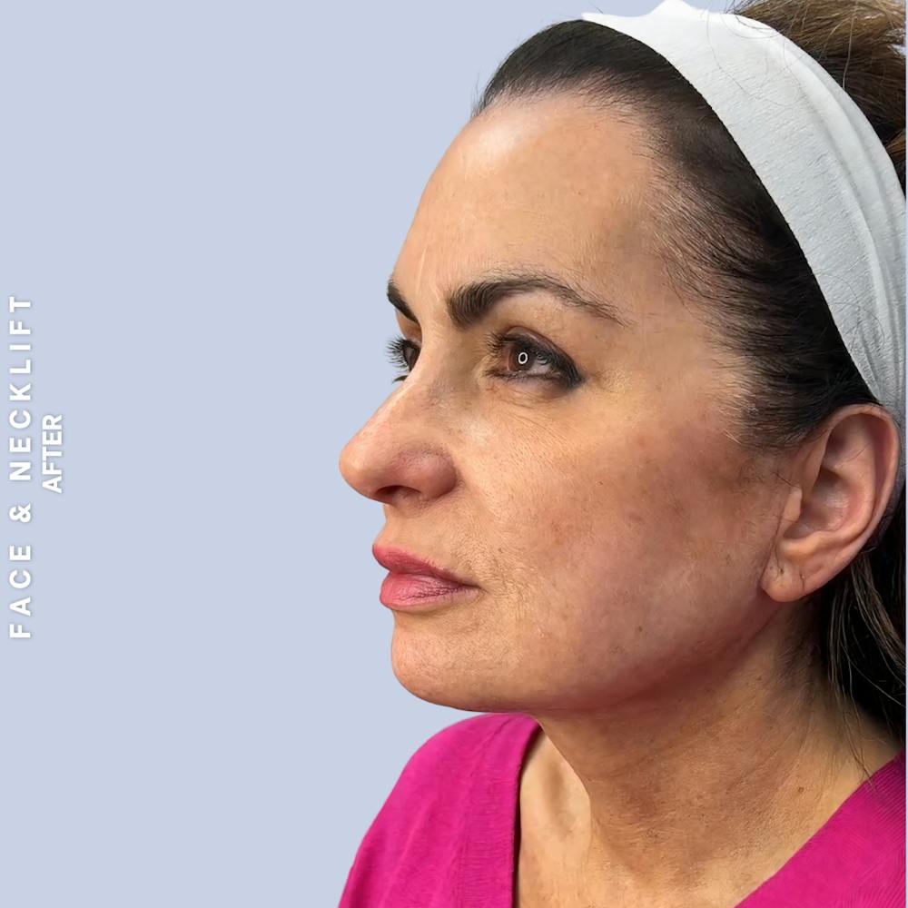 Face & Neck Before & After Gallery - Patient 271682 - Image 8