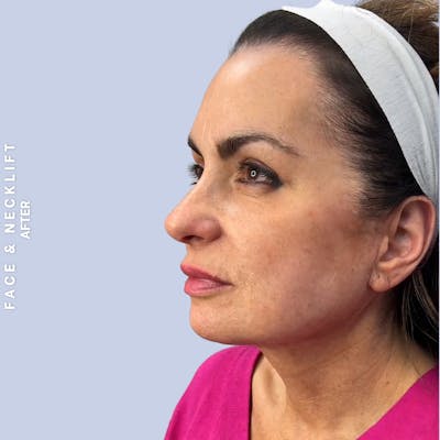 Face & Neck Before & After Gallery - Patient 271682 - Image 8