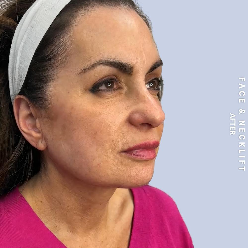 Face & Neck Before & After Gallery - Patient 271682 - Image 4