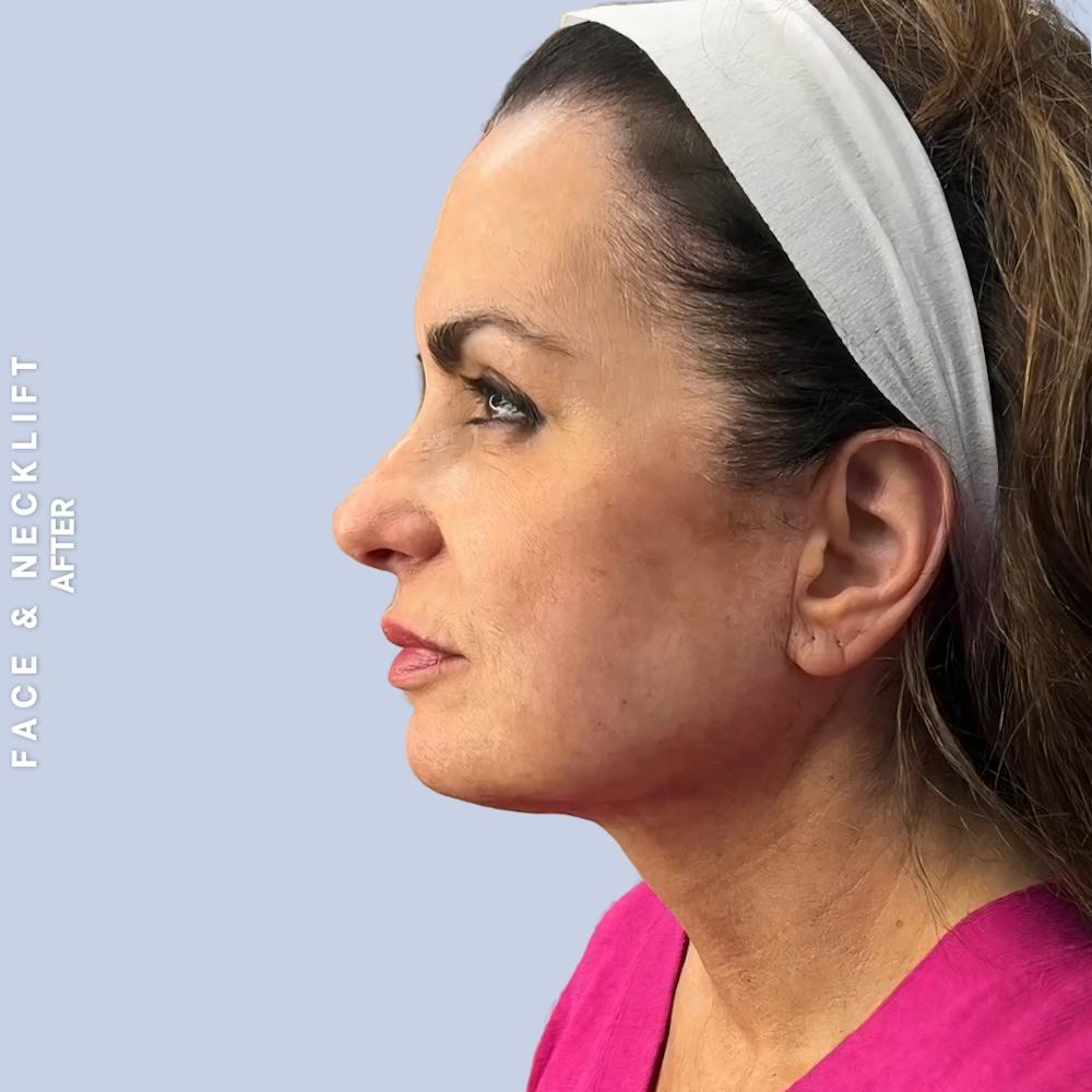 Face & Neck Before & After Gallery - Patient 271682 - Image 10