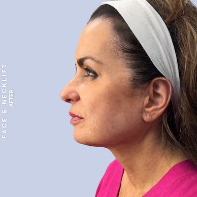 Face & Neck Before & After Gallery - Patient 271682 - Image 10