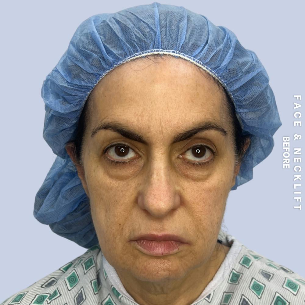 Face & Neck Before & After Gallery - Patient 271682 - Image 1
