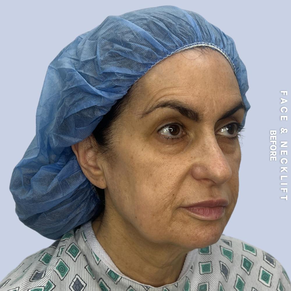 Face & Neck Before & After Gallery - Patient 271682 - Image 3