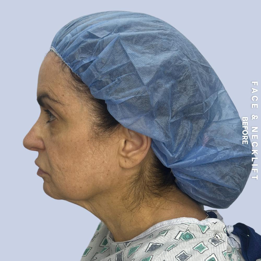 Face & Neck Before & After Gallery - Patient 271682 - Image 9
