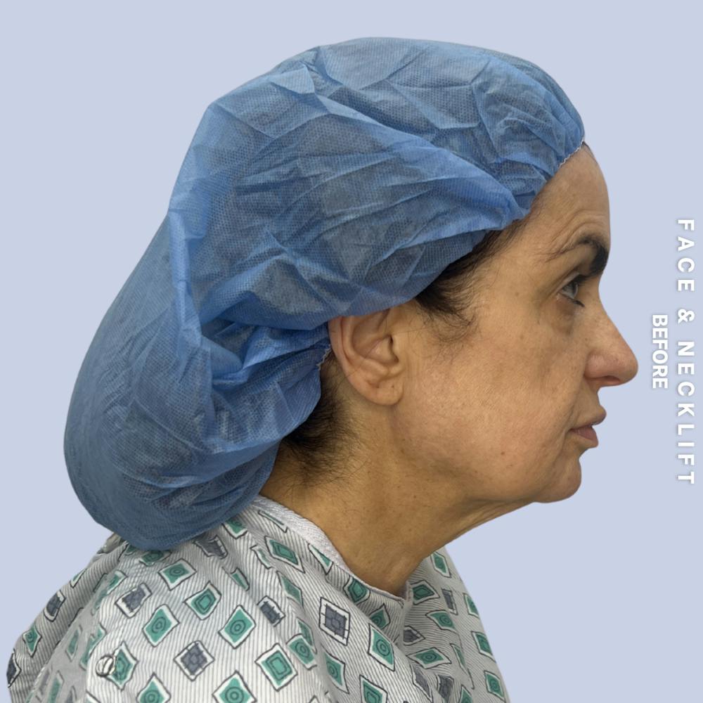 Face & Neck Before & After Gallery - Patient 271682 - Image 5
