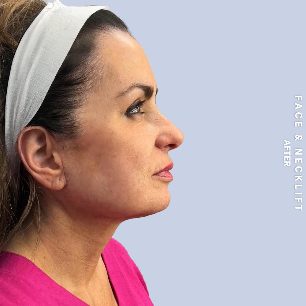 Face & Neck Before & After Gallery - Patient 271682 - Image 6