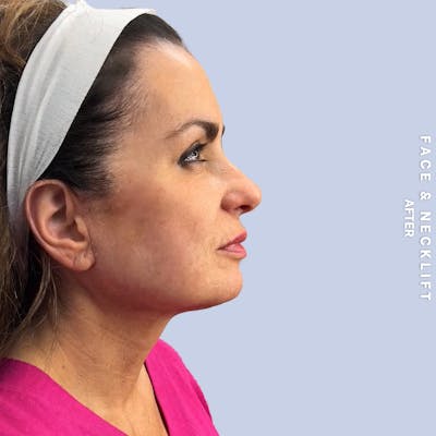 Face & Neck Before & After Gallery - Patient 271682 - Image 6