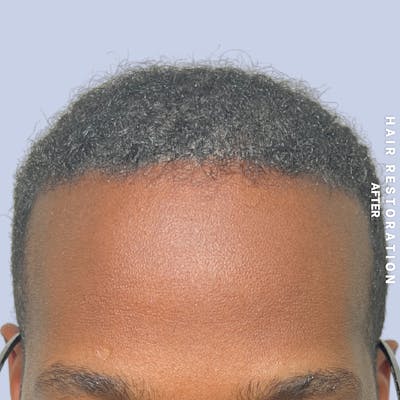 Hair Restoration Before & After Gallery - Patient 367978 - Image 2