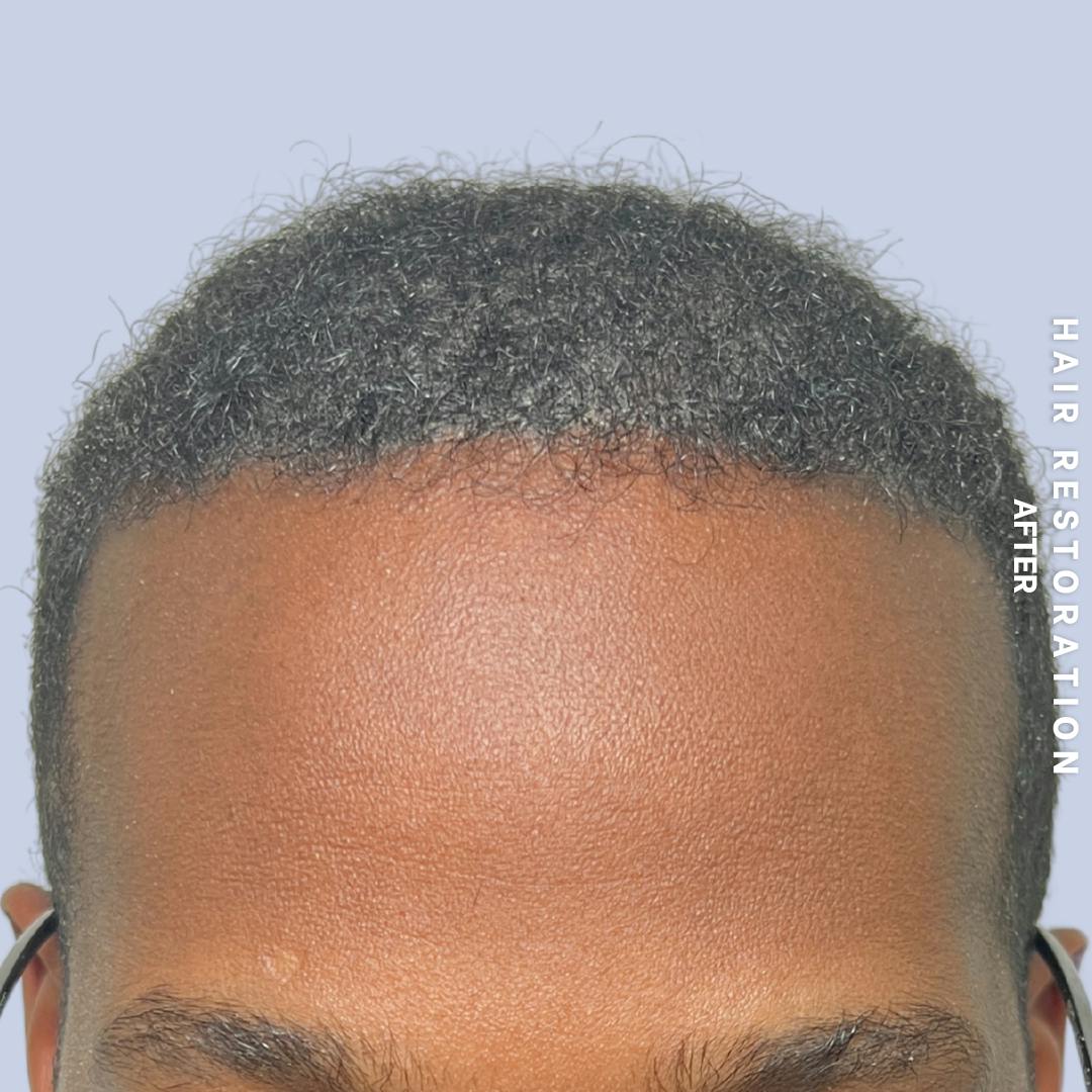 Hair Restoration Before & After Gallery - Patient 367978 - Image 2
