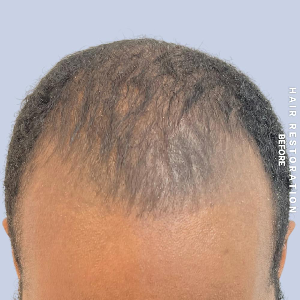 Hair Restoration Before & After Gallery - Patient 367978 - Image 1